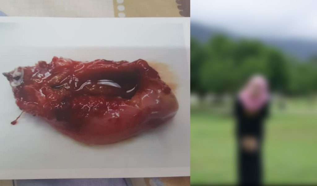 Gadis Kongsi Pengalaman Terpaksa Dibuang Hempedu 