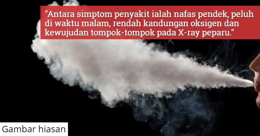 Evali Penyakit Baru Disebabkan Vape Jadi Punca 35 Maut Ribuan Menderita Penyakit Paru Paru